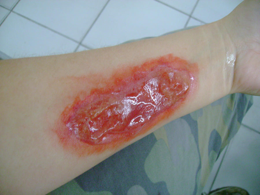 Second Degree Burn Pictures, Images & Photos | Photobucket